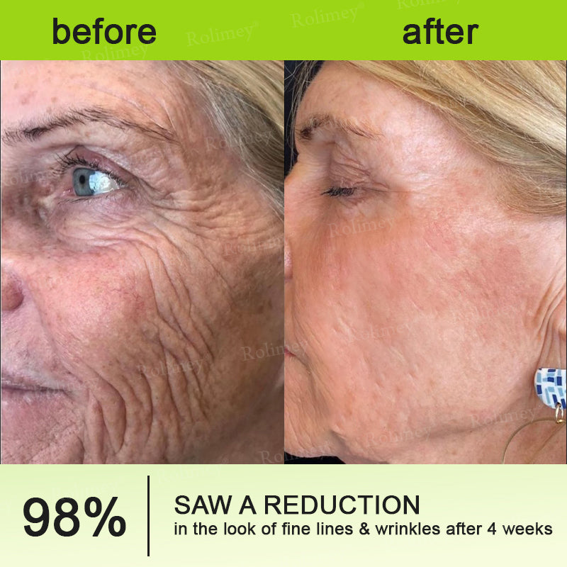 UPSELL👨‍⚕️💫Rolimey® Wrinkle-Lift Tightening cream