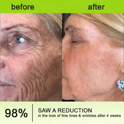 UPSELL👨‍⚕️💫Rolimey® Wrinkle-Lift Tightening cream